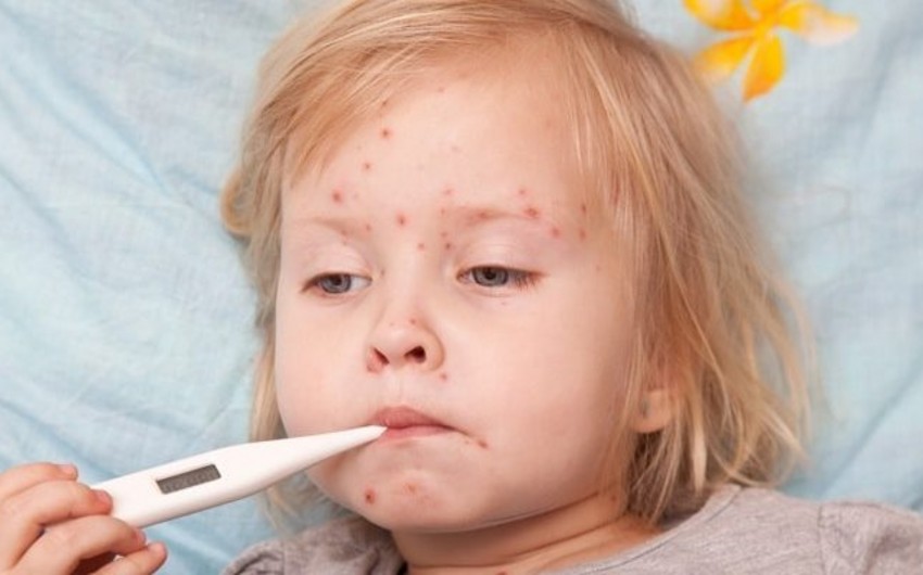 Həkim qızılca ilə bağlı valideynlərə çağırış edib