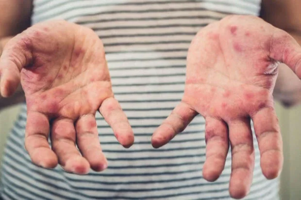 Həkim: “Qızılcanın karantin müddəti 21 gün, reabilitasiya müddəti 2-3 həftədir”